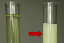 Nước tiểu trắng như sữa, người bệnh có thể chết do xơ gan, lao phổi...