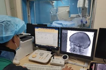 Mù sau tiêm filler ở nước ngoài, bệnh nhân về cầu cứu bác sĩ Việt Nam