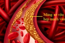 Bác sĩ mách cách giảm nguy cơ hẹp mạch máu não, phòng đột quỵ