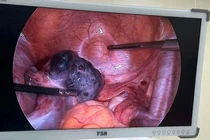 Nhận biết triệu chứng điển hình của u buồng trứng xoắn cần đến viện gấp