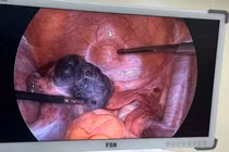 Nhận biết triệu chứng điển hình của u buồng trứng xoắn cần đến viện gấp