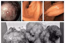 Cắt tách niêm mạc qua nội soi lấy polyp lớn dạ dày ung thư hóa