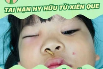  Ăn thịt xiên nướng, bé gái bị xiên que đâm từ mũi lên hốc mắt