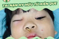  Ăn thịt xiên nướng, bé gái bị xiên que đâm từ mũi lên hốc mắt