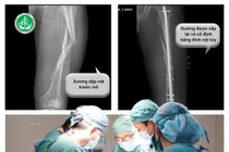 Cây đổ đè trúng người, nam thanh niên bị dập nát xương đùi trái