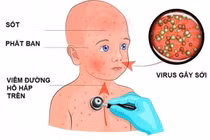 Bệnh sởi - những điều bố mẹ cần biết để phòng trong mùa dịch