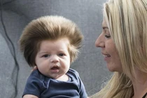 Tóc trẻ dựng đứng, có phải bệnh cam?