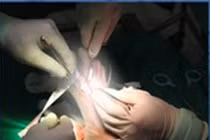 Vi phẫu tạo hình chuyển ngón chân lên tái tạo ngón tay cái