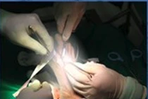 Vi phẫu tạo hình chuyển ngón chân lên tái tạo ngón tay cái