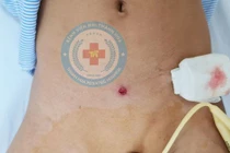 Trẻ 5 tuổi bị đạn súng cao su bắn thủng 5 lỗ ruột non