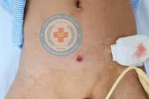 Trẻ 5 tuổi bị đạn súng cao su bắn thủng 5 lỗ ruột non