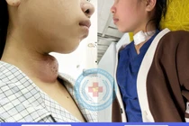 Lấy khối áp xe cổ 14 năm do dị tật khe hở mang cho trẻ
