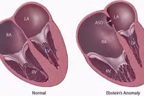 Mang thai đã sàng lọc, sau sinh trẻ tím tái vì dị tật tim bẩm sinh