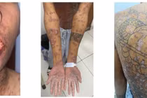 Điều trị thành công ca bệnh da đặc biệt hiếm gặp thứ 10 trên thế giới