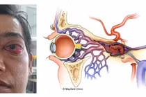 Điều trị thành công cho bệnh nhân bị lồi mắt sau tai nạn