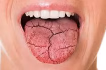 Bài thuốc độc đáo chữa chứng khô miệng vào ban đêm