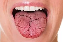 Bài thuốc độc đáo chữa chứng khô miệng vào ban đêm