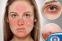 Đa dạng biến chứng trên cơ thể do Lupus ban đỏ nhiều người không biết