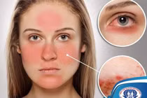 Đa dạng biến chứng trên cơ thể do Lupus ban đỏ nhiều người không biết