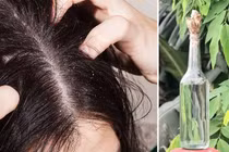 Ủ chấy bằng rượu ngâm hạt na, hai mẹ con bỏng giác mạc phải nhập viện