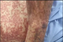 Sử dụng nhiều thuốc cụ già 78 tuổi suy giảm ý thức, nổi ban khắp người