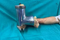 Bác sĩ "hồi sinh" bàn tay phải bị dập nát do máy xay thịt