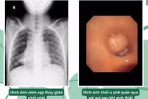 Ho kéo dài bé trai 10 tuổi phát hiện u ác phế quản phổi hiếm gặp