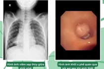 Ho kéo dài bé trai 10 tuổi phát hiện u ác phế quản phổi hiếm gặp