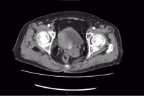 Tạo hình bàng quang bằng ruột non cứu bệnh nhân ung thư thoát khỏi án tử