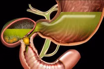 Chủ quan sỏi túi mật nhiều năm cụ ông 97 tuổi bị tắc ruột 