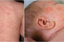 Bộ Y tế chỉ đạo tổ chức ngay chiến dịch tiêm vaccine ngừa sởi