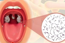 Phân biệt bệnh bạch hầu họng với các chứng viêm họng, amidan thông thường