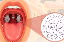 Phân biệt bệnh bạch hầu họng với các chứng viêm họng, amidan thông thường