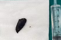 Ho, khó thở 3 tháng mới phát hiện mắc hạt hồng xiêm trong phế quản