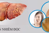 Thải độc gan sai cách… coi chừng hại cơ thể