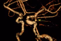 Đang nhặt rau đau đầu không ngờ vỡ túi phình mạch não phức tạp