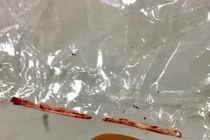 Hy hữu: Xương cá dài 4m trong gan của nam thanh niên