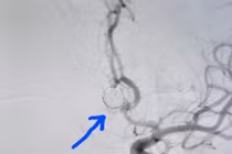 Phình mạch máu não – “Sát thủ thầm lặng” không thể coi thường