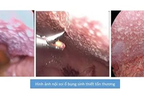 Đang khỏe mạnh tự nhiên chướng bụng không ngờ do lao màng bụng