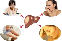 Bác sĩ chỉ rõ dấu hiệu "cầu cứu" của gan, cần thải độc, thanh lọc ngay