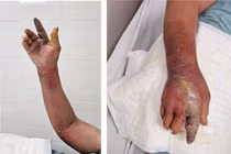 Chó cắn hoại tử cánh tay do viêm mô tế bào: