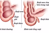 Bác sĩ chỉ cách chăm sóc trẻ tháo lồng ruột bằng hơi tại nhà