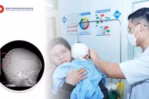 Ngã ngửa khi vui chơi, bé trai 23 tuổi bị đinh vít đâm vào đầu