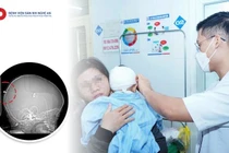 Ngã ngửa khi vui chơi, bé trai 23 tuổi bị đinh vít đâm vào đầu