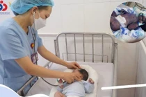 Cứu sống trẻ 22 ngày tuổi nguy kịch do bị thủy đậu toàn thân