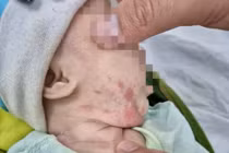 Bé trai 2 tháng tuổi loét khắp người vì mắc giang mai bẩm sinh