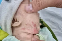 Bé trai 2 tháng tuổi loét khắp người vì mắc giang mai bẩm sinh