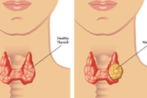  Uống hormon tuyến giáp quá liều... chữa bệnh nọ xọ bệnh kia