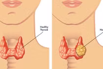  Uống hormon tuyến giáp quá liều... chữa bệnh nọ xọ bệnh kia