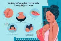 Viêm tuyến giáp sau sinh dễ nhiễm độc, suy giáp